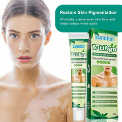 Sumifun Vitiligo Treatment Ointment