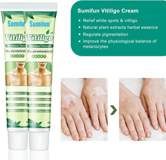 Sumifun Vitiligo Treatment Ointment