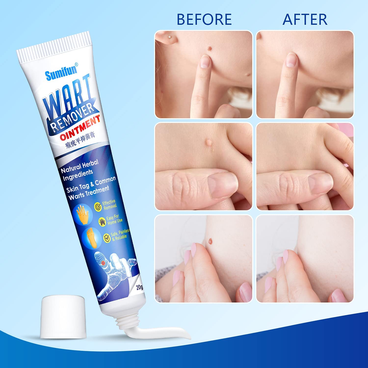 Sumifun Wart Remover Ointment