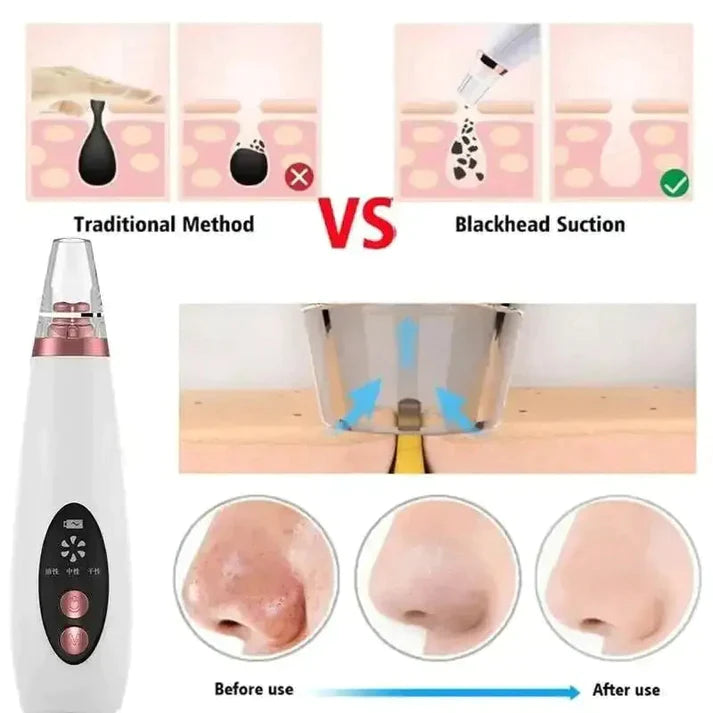 Blackhead Remover 6 In 1 Rechargeable