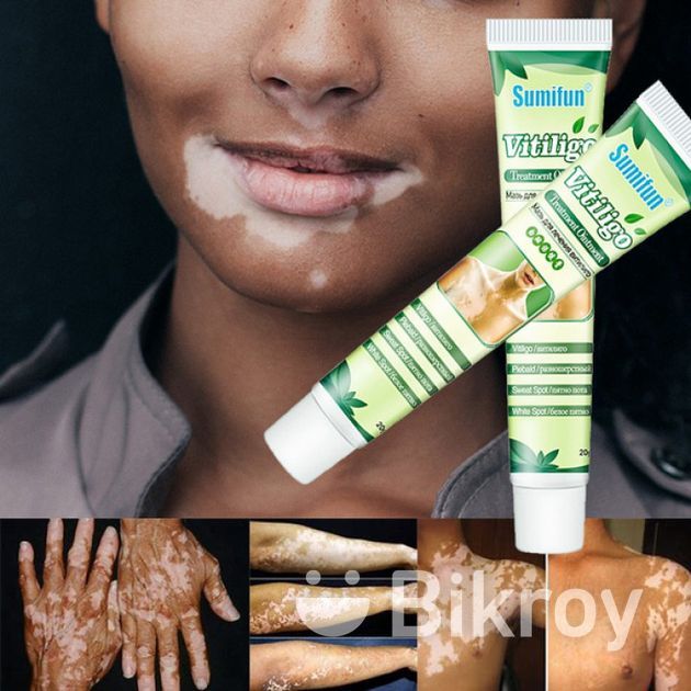 Sumifun Vitiligo Treatment Ointment